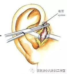 小耳手术成人能做吗视频,重塑自信，重拾美丽